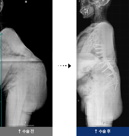 결핵성 후만증 수술 전,후