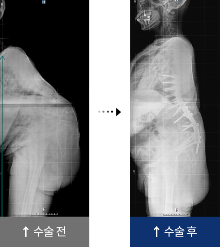 결핵성 후만증 수술 전,후