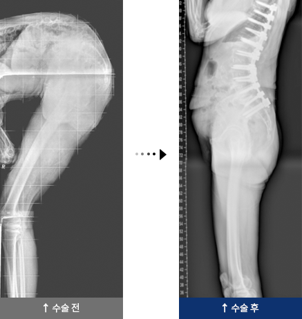 퇴행성 요추 후만증 수술 전,후