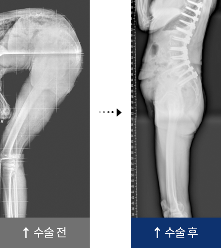 퇴행성 요추 후만증 수술 전,후