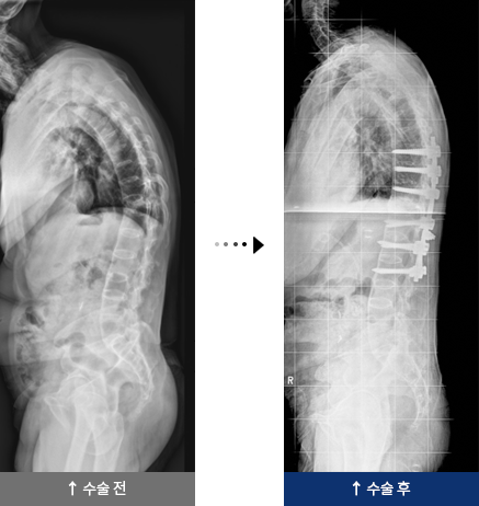 강직성 척추염 수술 전,후