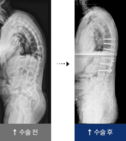 강직성 척추염 수술 전,후