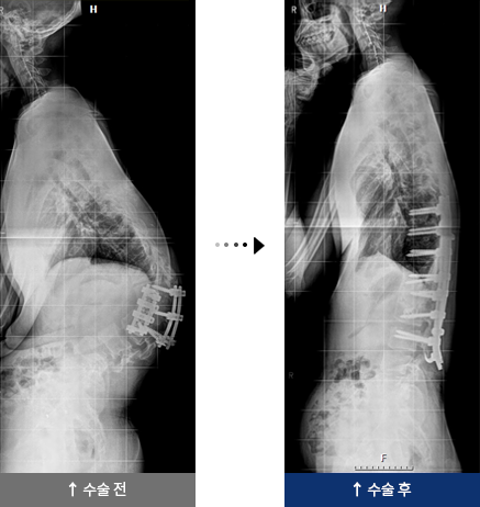 척추 재수술 수술 전, 후
