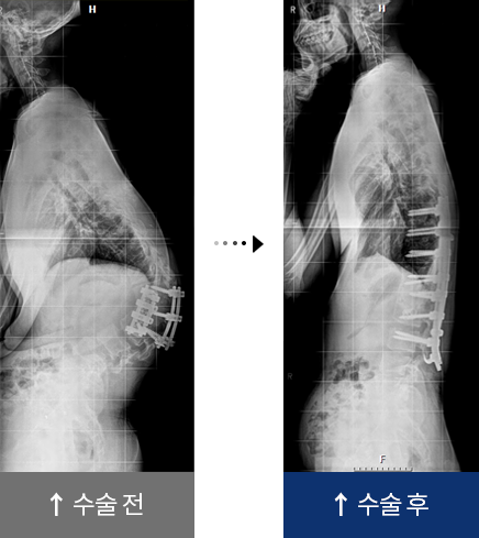 척추 재수술 수술 전,후