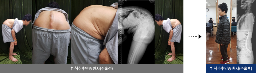 척추후만증 환자(수술전), 척추후만증 환자(수술후)