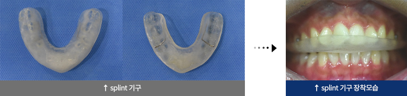 splint 기구, splint 기구 장착모습