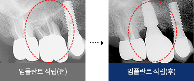 임플란트 식립(전), 임플란트 식립(후)