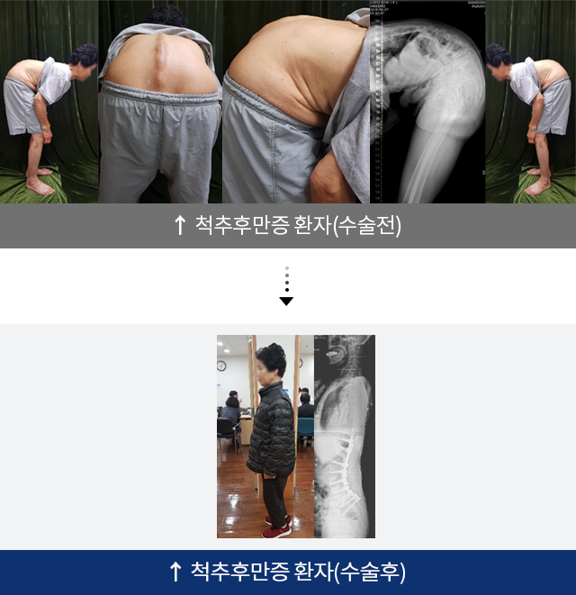 척추후만증 환자(수술전), 척추후만증 환자(수술후)