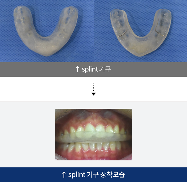 splint 기구, splint 기구 장착모습