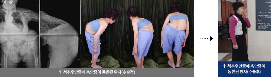 척추후만증에 측만증이 동반된 환자(수술전), 척추후만증에 측만증이 동반된 환자(수술후)