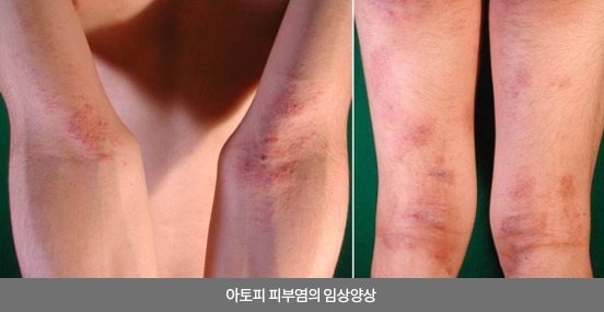 아토피 피부염의 임상양상