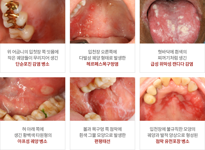 위 어금니의 입첫장 쪽 잇몸에 작은 궤양들이 무리지어 생긴 단순포진 감염 병소/ 입천장 오른쪽에 다발성 궤양 형태로 발생한 헤르페스목구멍염/ 혓바닥에 흰색의 찌꺼기처럼 생긴 급성 위막성 캔디다 감염/ 혀 아래 쪽에 생긴 황백색 타원형의 아프성 궤양 병소/ 볼과 목구멍 쪽 점막에 흰색 그물 모양으로 발생한 편평태선/ 입천장에 불규칙한 모양의 궤양과 발적 양상으로 형성된 점막 유천포창 병소