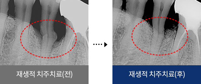 재생적 치주치료(전), 재생적 치주치료(후)