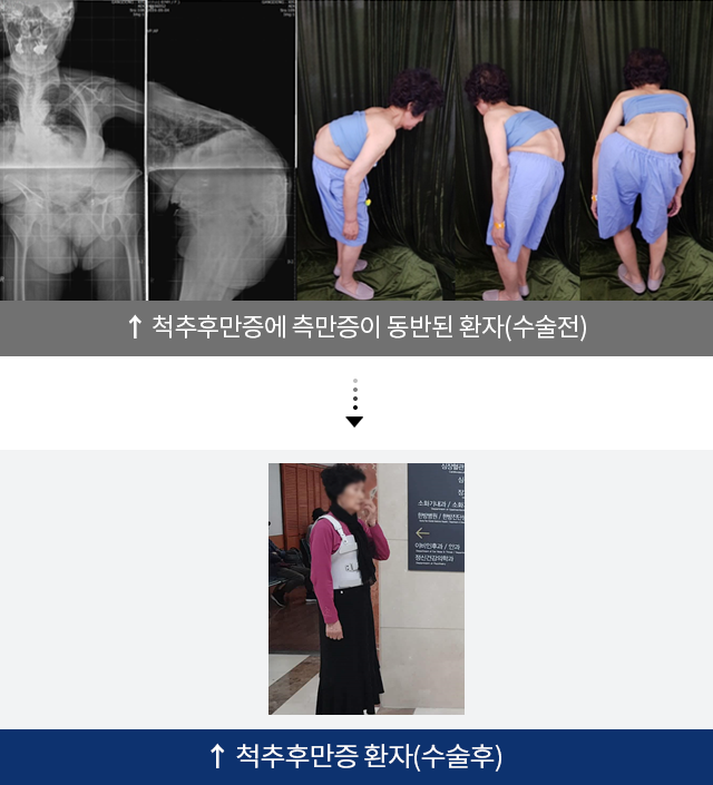 척추후만증에 측만증이 동반된 환자(수술전), 척추후만증에 측만증이 동반된 환자(수술후)