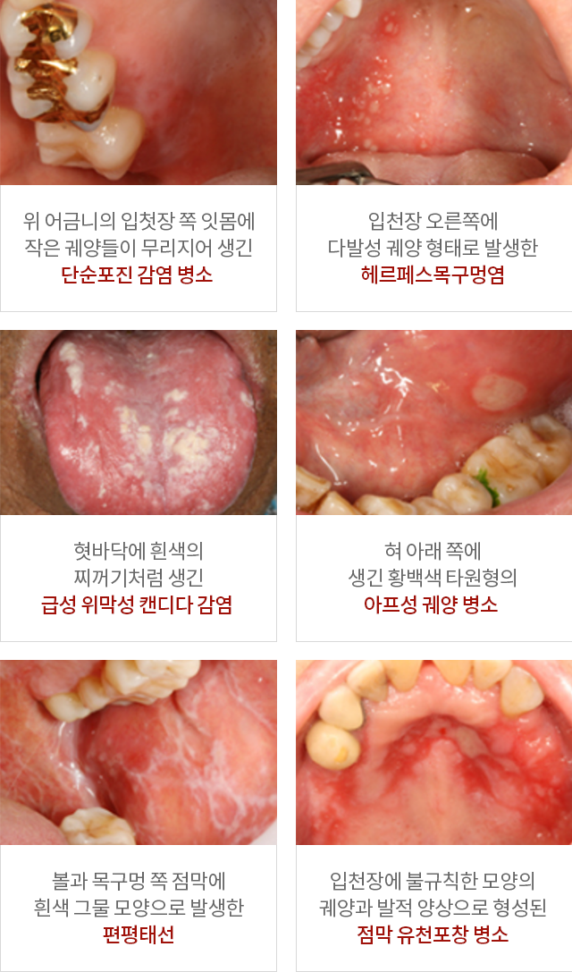 위 어금니의 입첫장 쪽 잇몸에 작은 궤양들이 무리지어 생긴 단순포진 감염 병소/ 입천장 오른쪽에 다발성 궤양 형태로 발생한 헤르페스목구멍염/ 혓바닥에 흰색의 찌꺼기처럼 생긴 급성 위막성 캔디다 감염/ 혀 아래 쪽에 생긴 황백색 타원형의 아프성 궤양 병소/ 볼과 목구멍 쪽 점막에 흰색 그물 모양으로 발생한 편평태선/ 입천장에 불규칙한 모양의 궤양과 발적 양상으로 형성된 점막 유천포창 병소