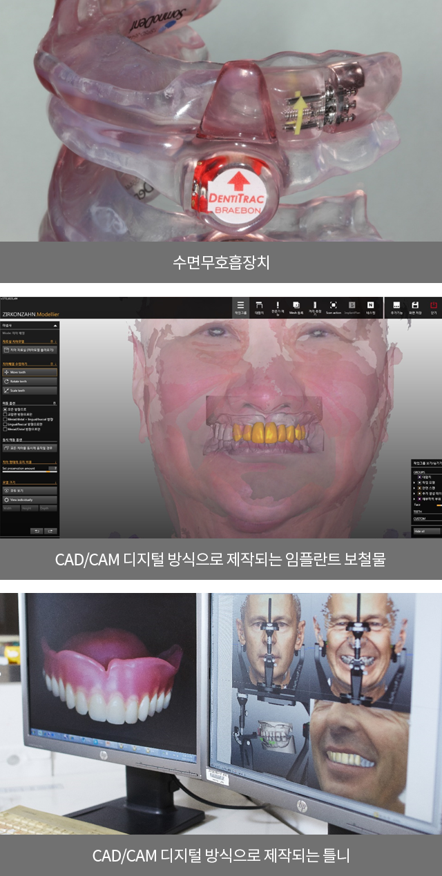 수면무호흡장치/ CAD/CAM 디지털 방식으로 제작되는 임플란트 보철물/ CAD/CAM 디지털 방식으로 제작되는 틀니