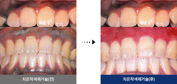 치은착색제거술(전), 치은착색제거술(후)