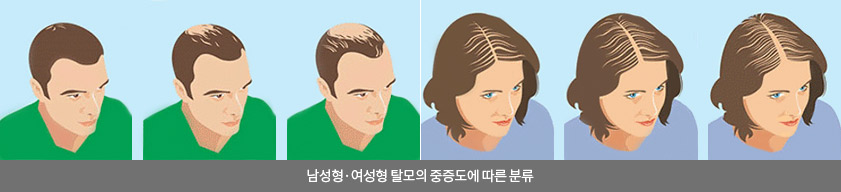 남성형·여성형 탈모의 중증도에 따른 분류