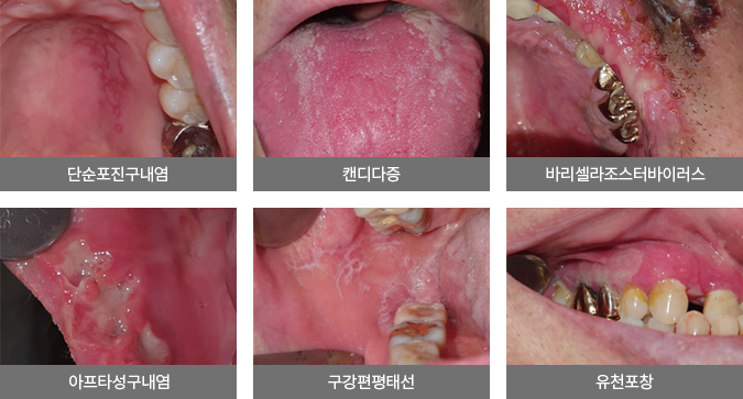 단순포진구내염 / 캔디다증/ 바리셀라조스터바이러스/ 아프타성구내염/ 구강편평태선/ 유천포창