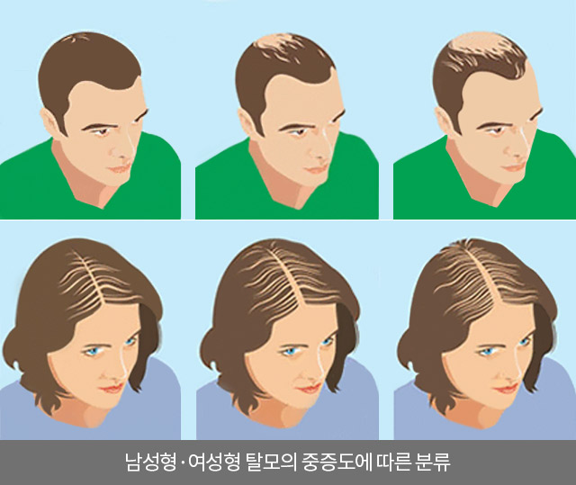남성형·여성형 탈모의 중증도에 따른 분류