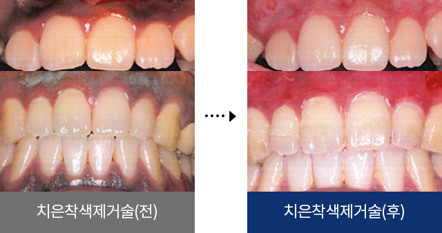 치은착색제거술(전), 치은착색제거술(후)