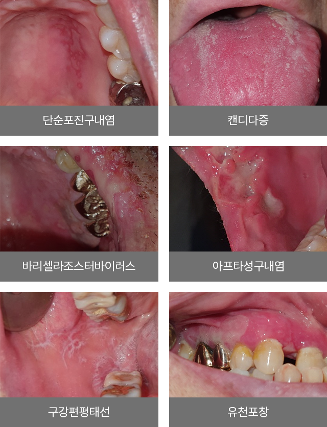 단순포진구내염 / 캔디다증/ 바리셀라조스터바이러스/ 아프타성구내염/ 구강편평태선/ 유천포창