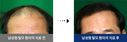 남성형 탈모 환자의 치료 전, 남성형 탈모 환자의 치료 후