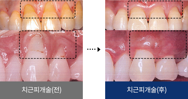 치근피개술(전), 치근피개술(후)