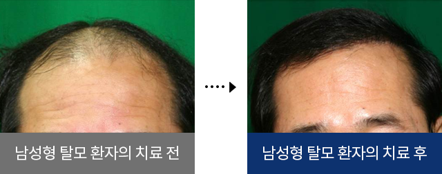 남성형 탈모 환자의 치료 전, 남성형 탈모 환자의 치료 후