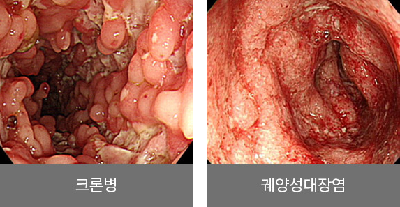 크론병, 궤양성대장염