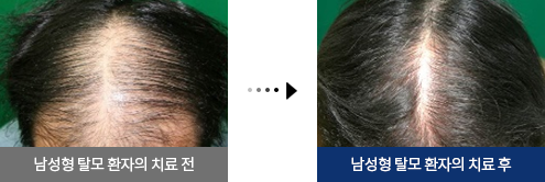 남성형 탈모 환자의 치료 전, 남성형 탈모 환자의 치료 후