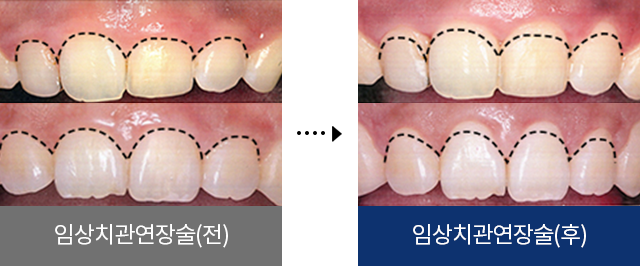 임상치관연장술(전), 임상치관연장술(후)
