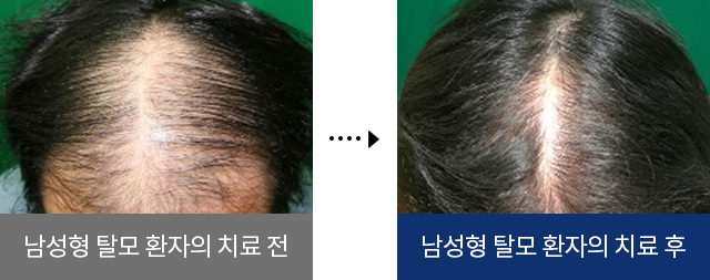 남성형 탈모 환자의 치료 전, 남성형 탈모 환자의 치료 후