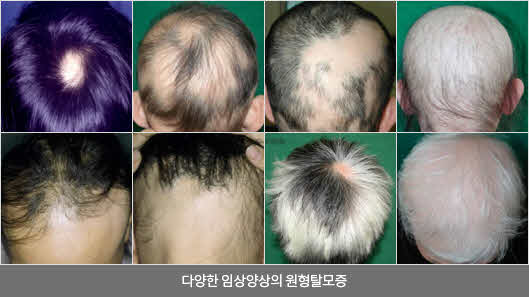 다양한 임상양상의 원형탈모증