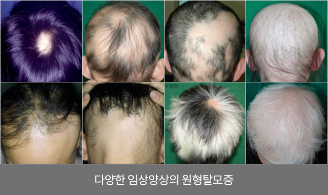 다양한 임상양상의 원형탈모증