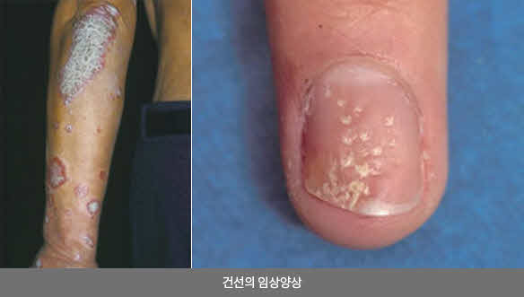건선의 임상양상