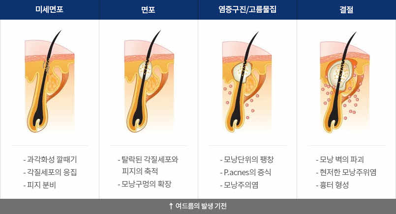 1. 미세면포 : 과각화성 깔때기, 각질세포의 응집, 피지 분비 2. 면포 : 탈락된 각질세포와 피지의 축적, 모낭구멍의 확장 3. 염증구진/고름물집 : 모낭단위의 팽창, P.acnes의 증식, 모낭주의염 4. 결절 : 모낭 벽의 파괴, 현저한 모낭주위염, 흉터 형성