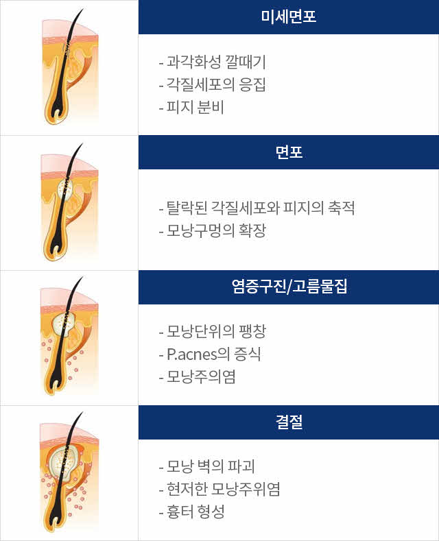 1. 미세면포 : 과각화성 깔때기, 각질세포의 응집, 피지 분비 2. 면포 : 탈락된 각질세포와 피지의 축적, 모낭구멍의 확장 3. 염증구진/고름물집 : 모낭단위의 팽창, P.acnes의 증식, 모낭주의염 4. 결절 : 모낭 벽의 파괴, 현저한 모낭주위염, 흉터 형성