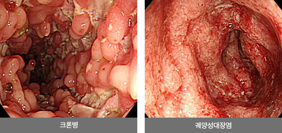 크론병, 궤양성대장염