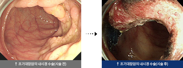 조기대장암의 내시경 수술(시술 전), 조기대장암의 내시경 수술(시술 후)
