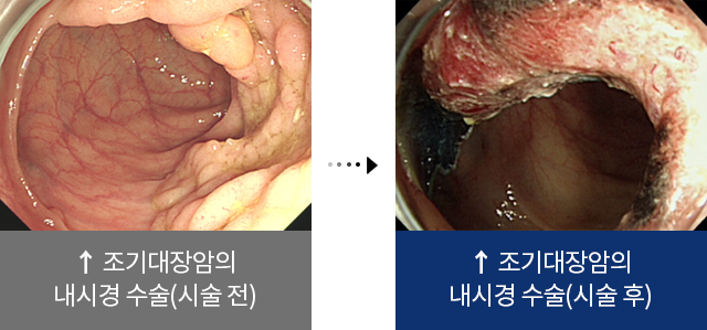 조기대장암의 내시경 수술(시술 전), 조기대장암의 내시경 수술(시술 후)
