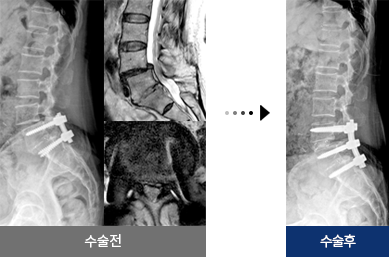 척추 재수술 이전 수술의 인접부위가 잘못된 경우 수술 전 후