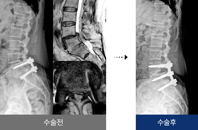 척추 재수술 이전 수술의 인접부위가 잘못된 경우 수술 전 후