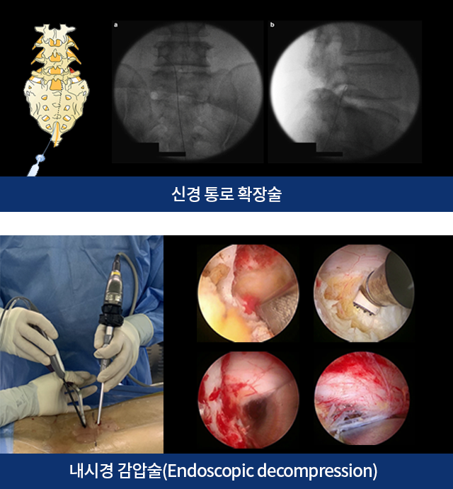 신경 통로 확장술, 내시경감압술