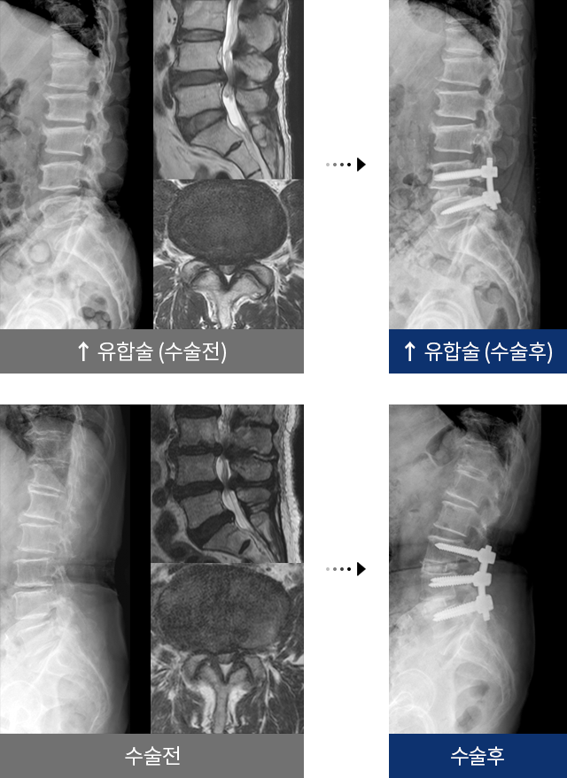 신경 통로 확장술, 내시경감압술