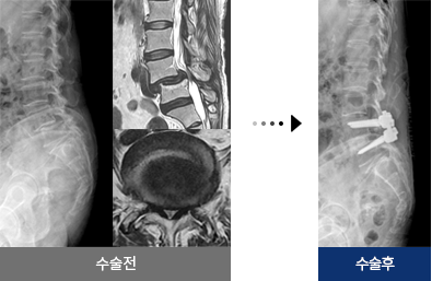 척추전방전위증 수술 전 후