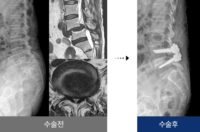 척추전방전위증 수술 전 후
