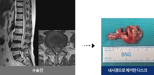 허리디스크(추간판탈출증) 수술 전 후