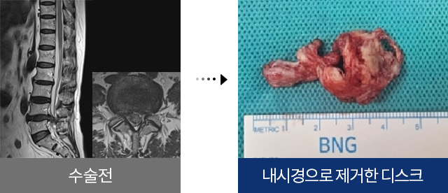 허리디스크(추간판탈출증) 수술 전 후