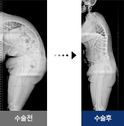 강직성척추염 수술 전 후